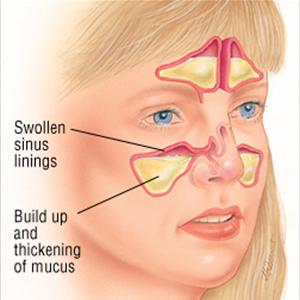 Sinositis Aguda - The General View And Medical Explanation Of Bronchiectasis