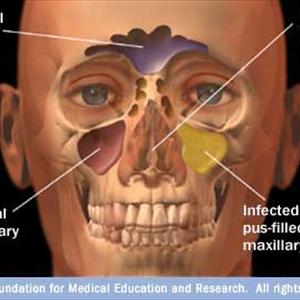 Cannot Get Rid Of Green Mucous In Sinuses - Treat Your Own Sinus Issues Right Away