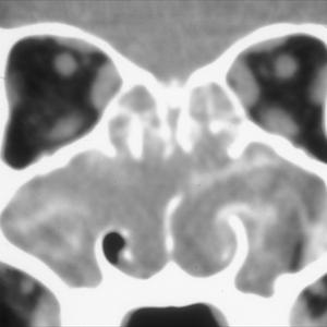 What Antibiotic Treats Maxillary Sinus - Nebulized Sinus Remedy Operates Wonders