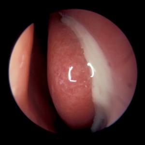  Say Bye To Sinusitis With Balloon Sinuplasty