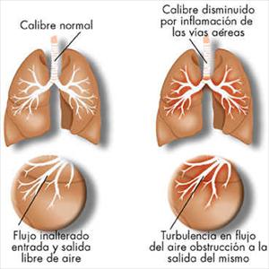 Untreated Sinus Infection 