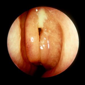 Best Guaranteed Natural Treatment For Sinusitis - What Triggers Your Asthma?