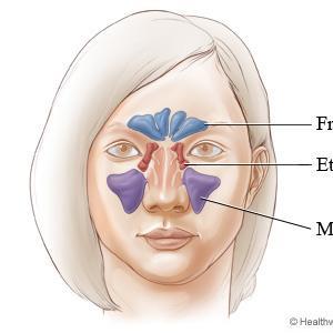 Signs Of Inflammation Of Sinus - Consult A Balloon Sinuplasty Doctor For Sinusitis
