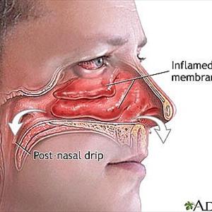 Headache Followed By Bloody Nose - Basic Information On Sinusitis Treatments