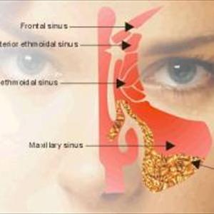 How To Treat Sinus Infections Naturally - Impacted Sinusitis Symptoms