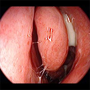 How To Tell If Nasal Is Completely Block - Advantages Of Topical Therapy For Sinusitis And Rhinitis Treatment