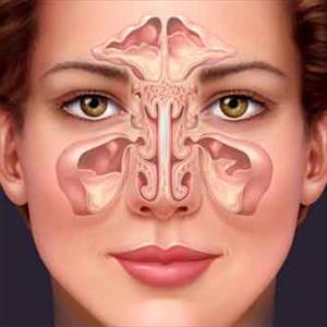 Chronic Sinus Herbal Treatment - Balloon Sinuplasty - A Safe And Effective Treatment