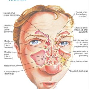 Sinus Problems Causing Swelling Of Eyes - Chronic Sinusitis In Children