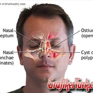 Small Mucus Retention Cyst Left Maxillary Sinus 