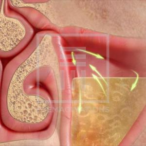 Sinus Dizzy - The General View And Medical Explanation Of Bronchiectasis