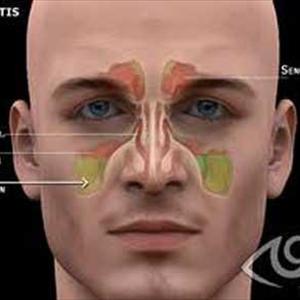 Cure Deep Sinus Congestion - Sinus Problems In Children