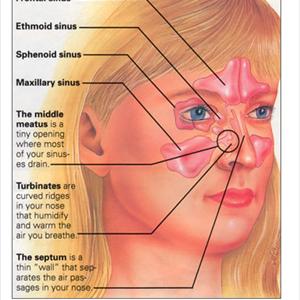 Maxillary Sinus Mucous Retention Cyst On Cheek 