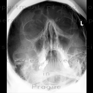 Natural Treatment For Sinus Cysts - Consult A Balloon Sinuplasty Doctor For Sinusitis