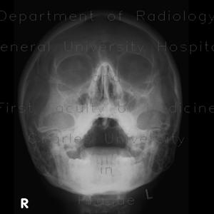  Sinus Problems In Children