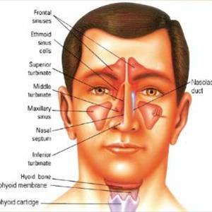 Drain Sinus Homeopathically - Acute And Chronic Sinusitis
