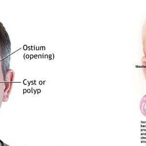 Can Alcohol Irritate Sinuses 