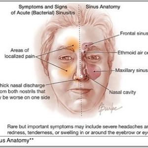 What Do Sinuses Headaches Mean Spiritually 