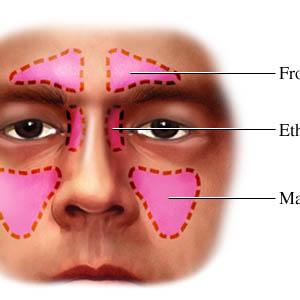 Sinus Remedies - All About Sinusitis