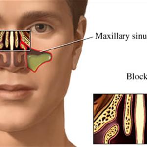 Sugar Causing Sinus Inflammation - Sinus An Infection Therapy Guidebook