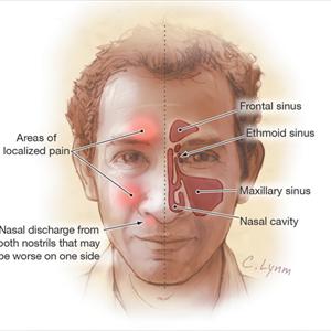 Can Sinus Cause Bad Breath 