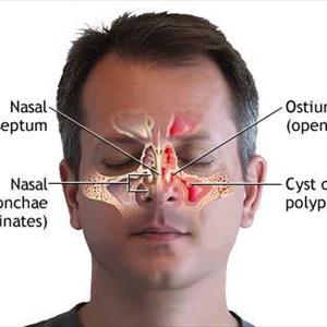 Sinuvil In Stores - You May Stay Away From Sinusitis!