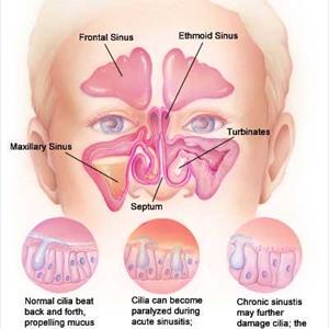  Top 5 Cures With Regard To Sinusitis That You Will Find At Home
