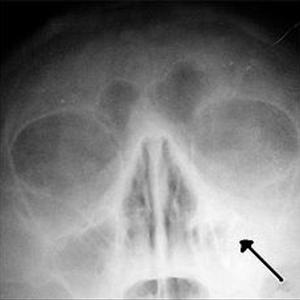 Best Medication For Sinus Pressure - Consult An Expert Balloon Sinuplasty Doctor For Sinusitis