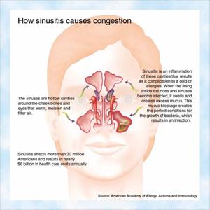 Blocked Sinus Natural Remedy - Sinusitis Discomfort