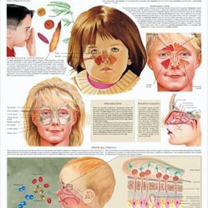 sinus infection viral bacterial